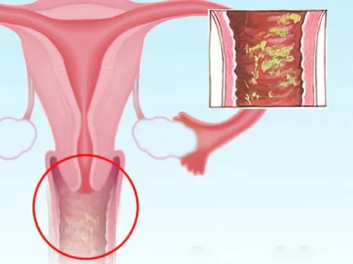 Fungal infection vagina