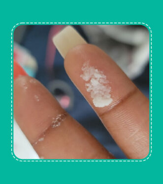 cottage cheese vaginal discharge 2 e1729439460307