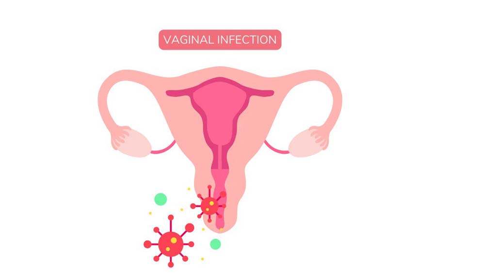 The most common types of infections in women