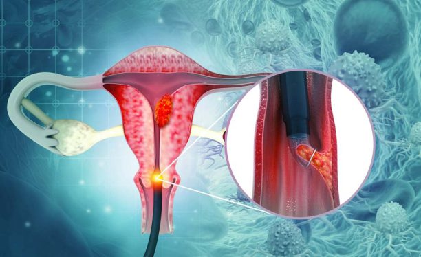 عفونت HPV و سرطان دهانه رحم