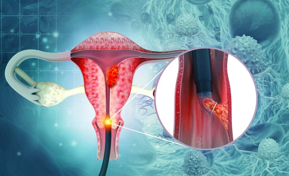 عفونت HPV و سرطان دهانه رحم