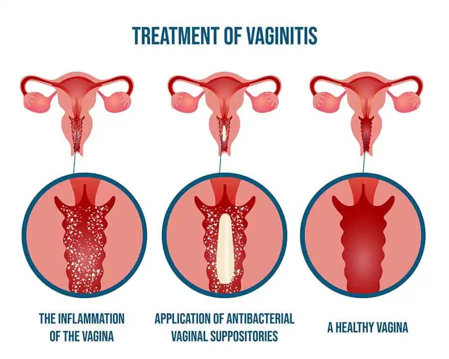 Incomplete or early treatment of vaginal yeast infection