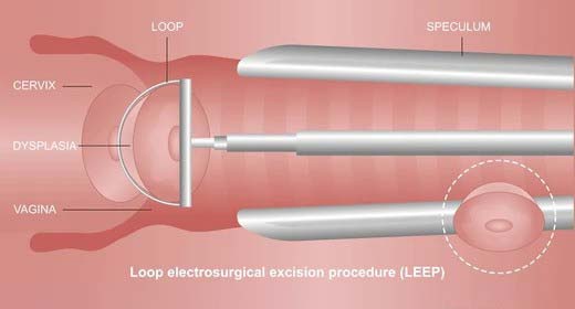 Loop electrosurgical excision procedure LEEP