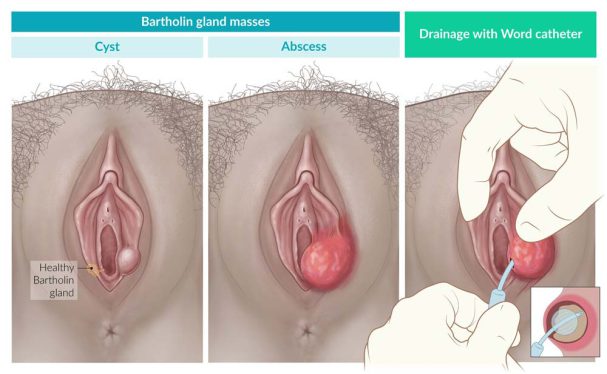 Methods for diagnosing and treating Bartholins cyst