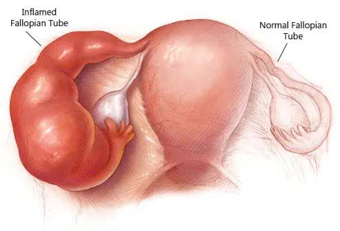 Pelvic inflammatory disease PID and fallopian tube damage