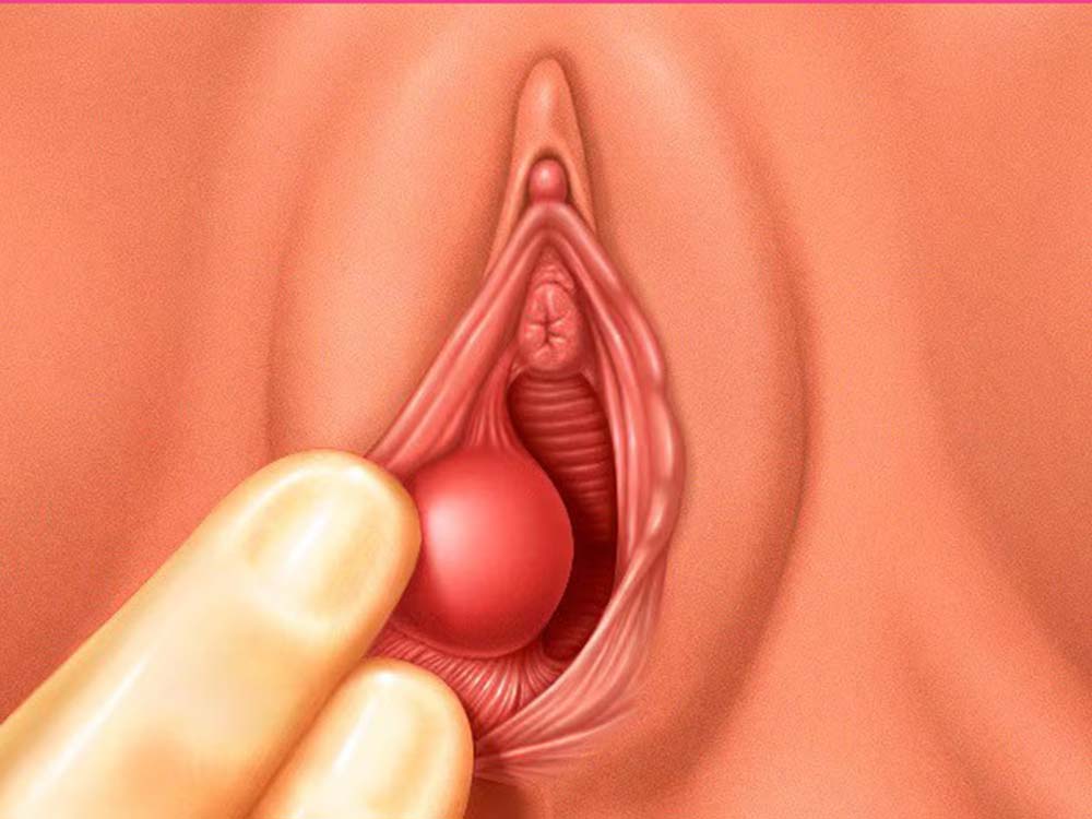 Signs and symptoms of Bartholins cyst and abscess