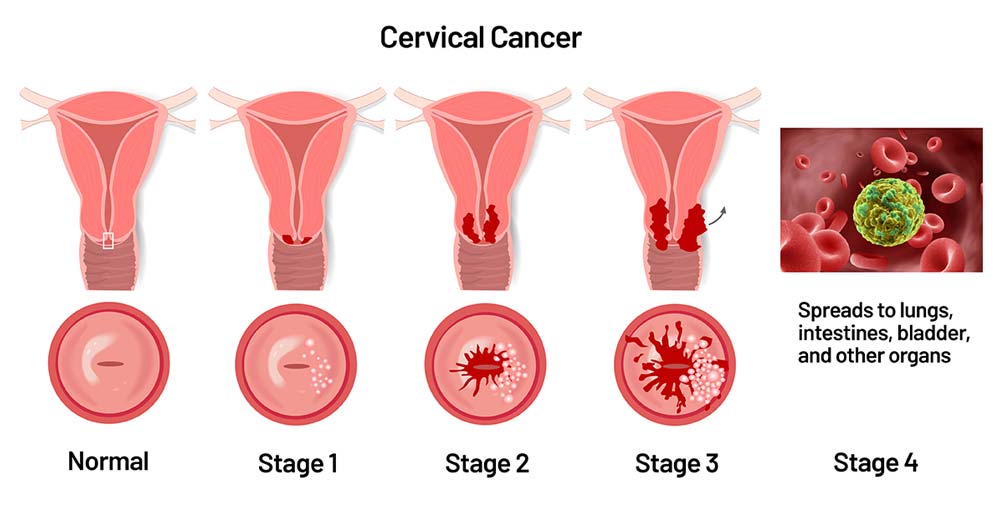 عفونت HPV و سرطان دهانه رحم