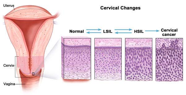 The connection between HPV and cervical cancer