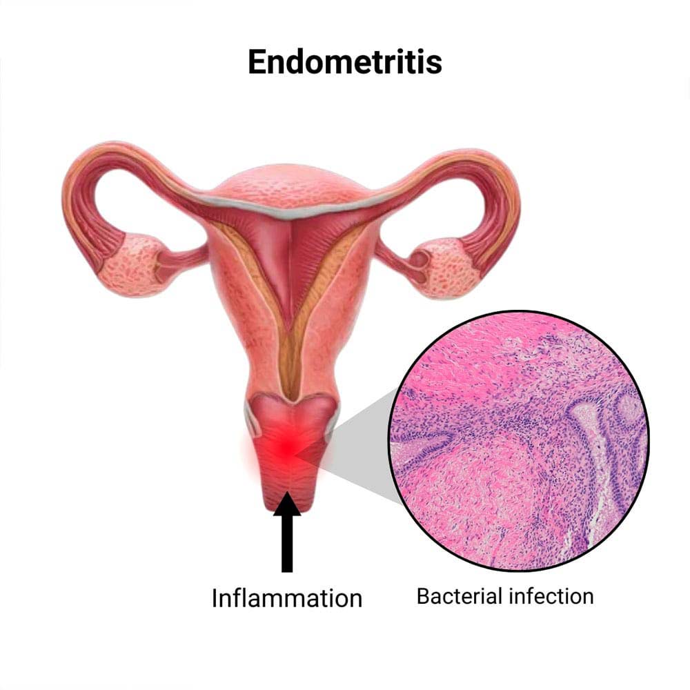 What is uterine infection endometritis