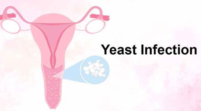 پیشگیری از عفونت قارچی
