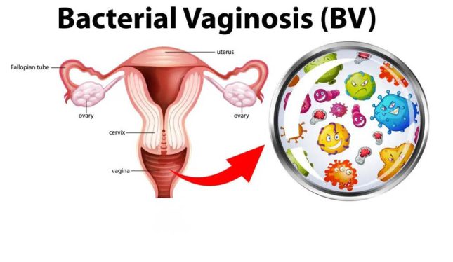 The role of sugar in bacterial vaginosis