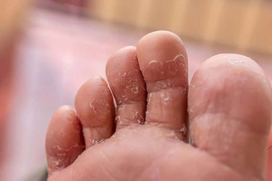 چگونگی جلوگیری از عفونت های قارچی در استخر 3 Tinea Pedis