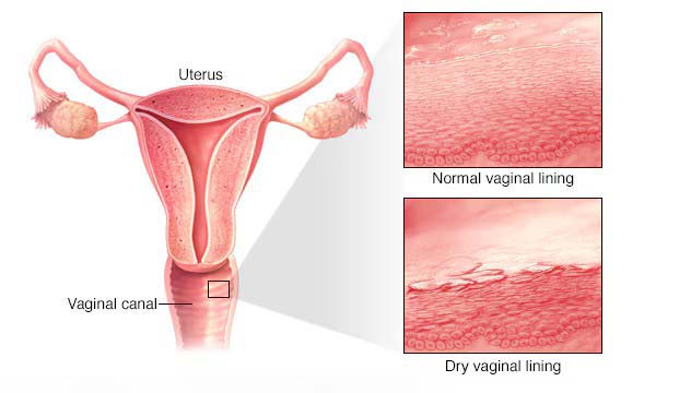 Vaginal Atrophy